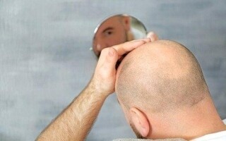 New Sugar Gel Promises Effective Treatment for Genetic Hair Loss