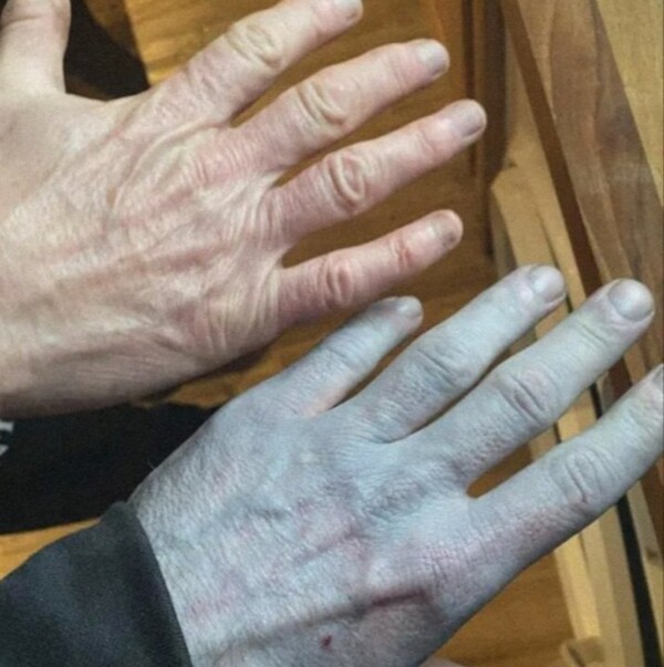 男子醒来皮肤变蓝，原因竟如此简单